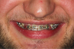 Mateusz_braces1.jpg