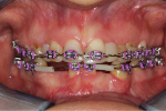 Jasmina_braces.jpg