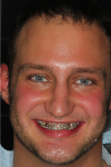 Mateusz_braces_face.jpg