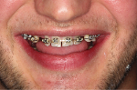 Mateusz_braces_open.jpg
